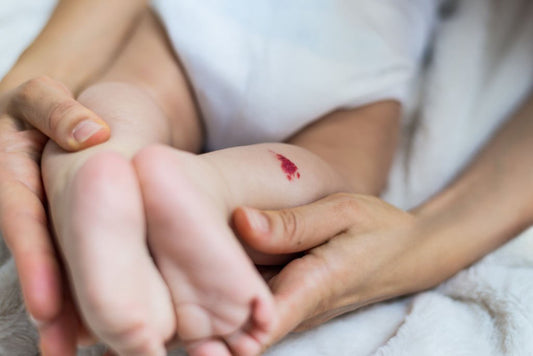 Tout ce que vous devez savoir sur l'angiome chez les bébés
